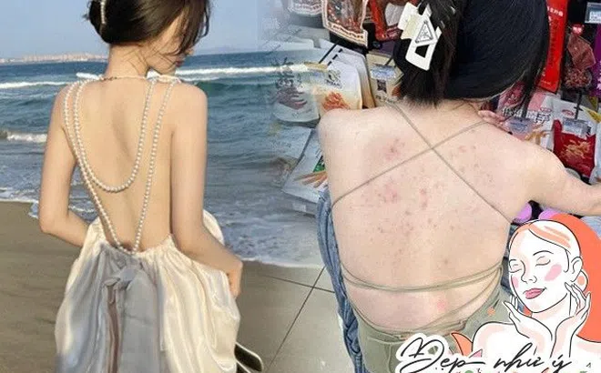 Mặc áo dây lộ tấm lưng chi chít mụn, là vì chị em chưa biết 10 cách trị mụn lưng giúp da trắng rẻ bèo này!