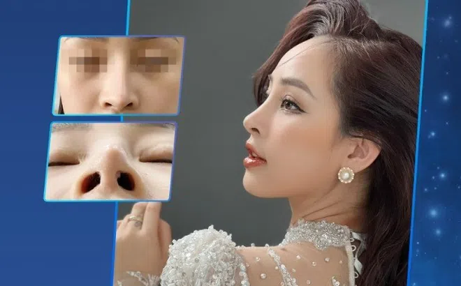 Thẩm mỹ Như Hoa: Địa chỉ nâng mũi uy tín, biến ước mơ thẩm mỹ thành hiện thực