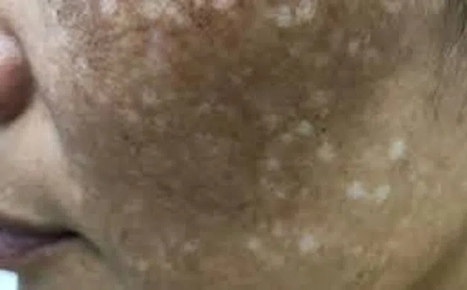 Đun nước lá trị nám theo Tiktok, 4 phụ nữ mặt loang lổ sau một đêm