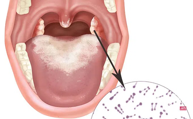 Mắc bệnh bạch hầu có thể khiến bệnh nhân tử vong trong vòng 6-10 ngày