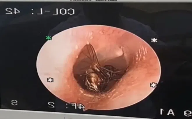 Clip: Hãi hùng cảnh tượng lấy con ruồi ra khỏi tai bệnh nhân