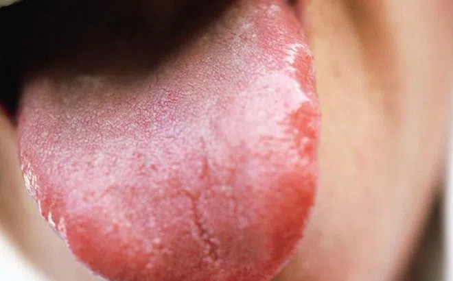 3 biểu hiện ở lưỡi cảnh báo bệnh tim nguy hiểm