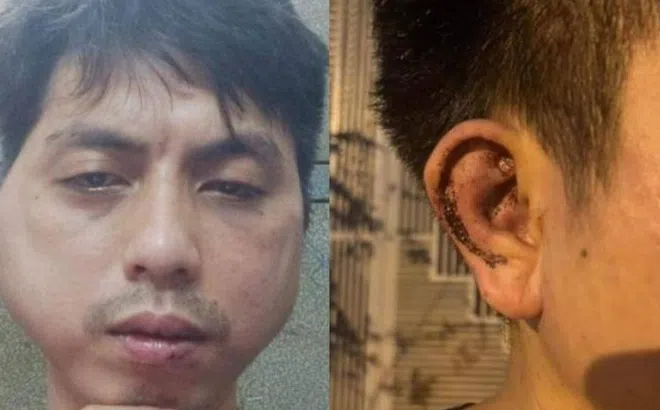 Nhân viên bị chủ quán lẩu đánh biến dạng khuôn mặt: Thương tích 7%