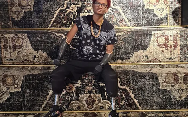 Người phụ nữ phải cắt cụt tứ chi sau khi bị muỗi đốt