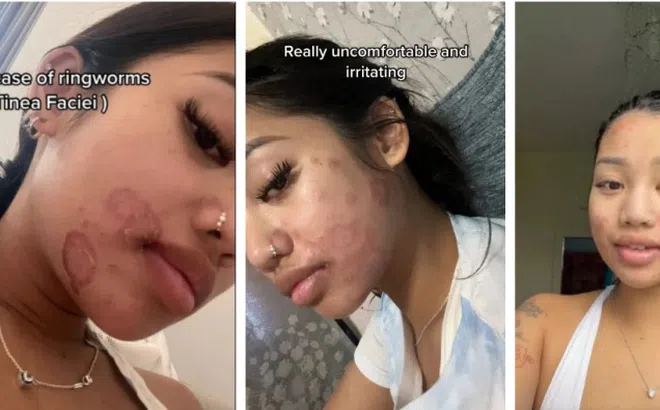 Cô gái nhiễm giun đũa khắp mặt, nguyên nhân khiến nhiều chị em bất ngờ