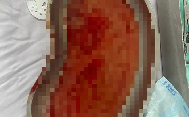 Biến dạng vì nâng ngực theo quảng cáo trên mạng xã hội