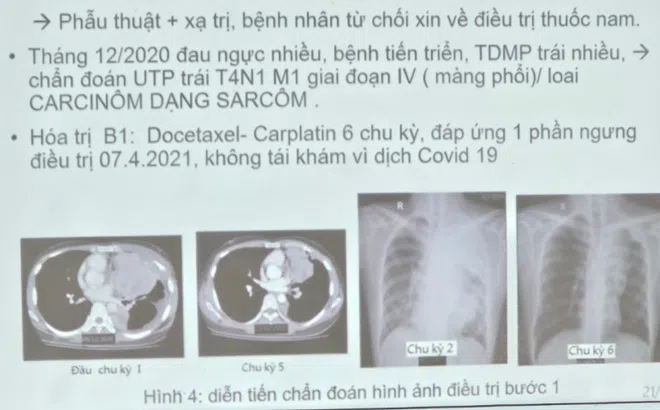 Phát hiện bệnh u phổi hiếm gặp ở người trẻ