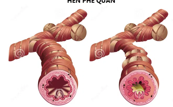 Hen suyễn ảnh hưởng lớn tới tình dục