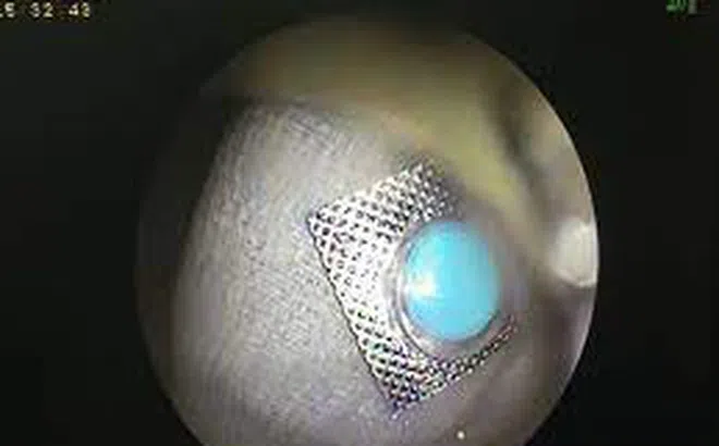 Uống thuốc nuốt luôn cả vỏ thiếc bên ngoài, người phụ nữ phải nhập viện cấp cứu