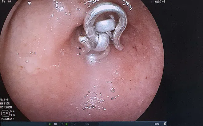 Kinh hoàng bé trai 8 tháng tuổi nuốt sợi dây chuyền bạc 15cm trong ổ bụng
