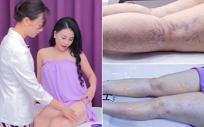 Giãn mao mạch mạng nhện: Da nổi gân máu chằng chịt chữa có khỏi được không?