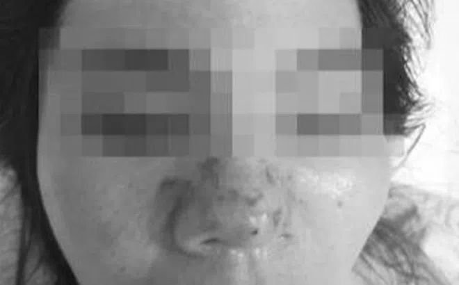 Hỏng cả mặt, mũi vì tiêm thử filler