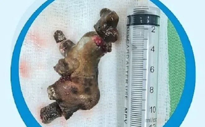 Nghệ An: Lấy viên sỏi san hô “khủng” từ bụng người đàn ông 58 tuổi