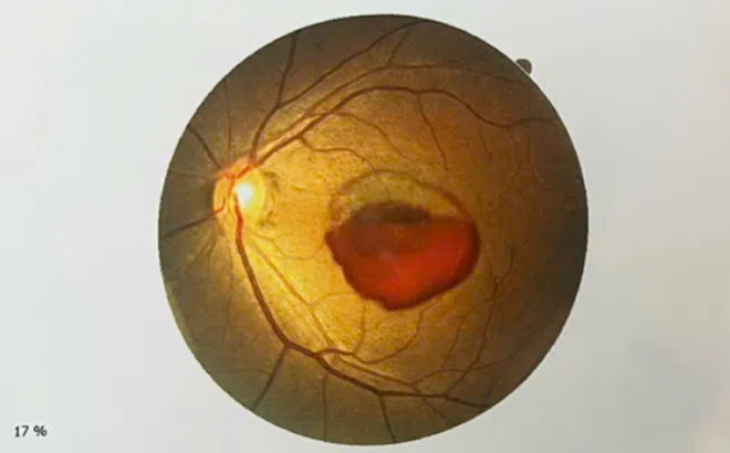 Cảnh báo mất thị lực sau khi tiếp xúc với tia laser