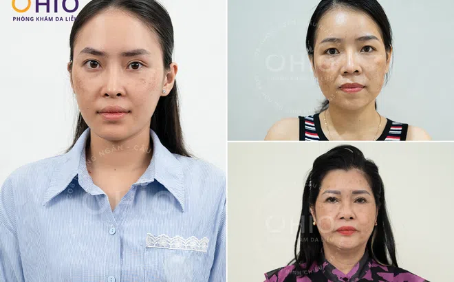 Trị nám, tàn nhang tại Vinh với phác đồ PBS Premium tại Phòng khám da liễu OHIO