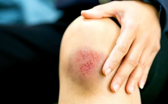 7 loại vết thương cần được xử lý ngay chớ chủ quan kẻo hối không kịp