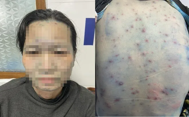 Nữ giáo viên mắc thủy đậu bội nhiễm sau khi tiếp xúc với hai học sinh mắc thủy đậu