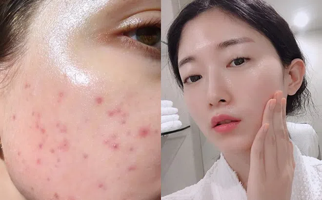 Bác sĩ da liễu chỉ đích danh lỗi sai "tày trời" khiến lỗ chân lông "toang hoác" mà chị em nào cũng mắc phải khi mùa Thu đến