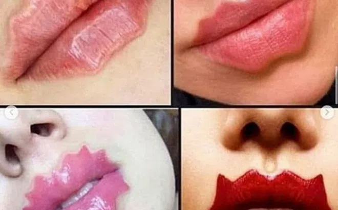 Trào lưu tiêm filler để tạo dáng môi "chẳng giống ai" của hội chị em: Độc đáo hay kinh dị?
