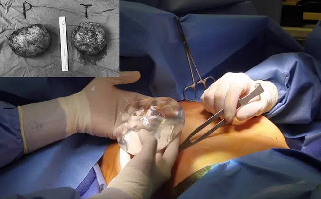 Cảnh báo vỡ túi độn ngực ở những người 'nâng cấp' vòng 1