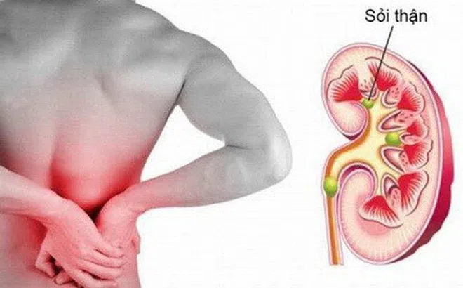 Những điều nên chú ý để phòng, tránh sỏi thận