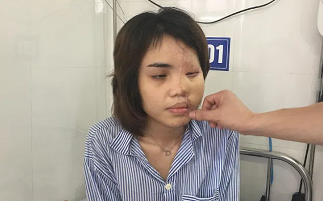 Bị chồng sắp cưới tạt axit hủy hoại nửa khuôn mặt, nhan sắc cô gái thay đổi ngoạn mục sau 2 năm