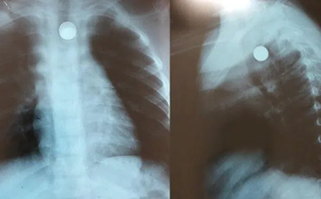 Từ vụ bé trai 5 tuổi nuốt phải bi sắt khi đang chơi, cha mẹ cần lưu ý các điều sau để tránh gây nguy hiểm cho con